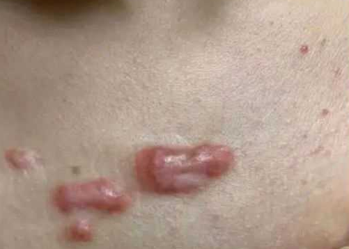 �������ܲ����̺��أ���Ҫע��ʲô���ൺ�̺�ҽԺ