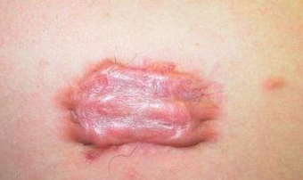 ���˻��˺󲢷�֢�ͺ���֢-�����̺�