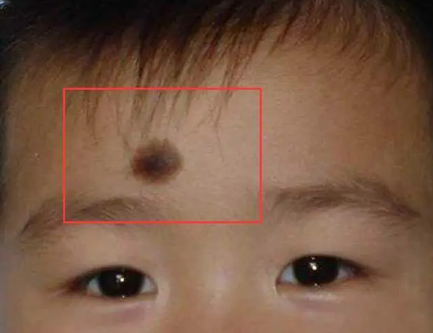 �ൺƤ����ҽԺ̥�ǵ�Σ��5��̥�ǽ��ܣ��ൺ��������̥�ǱȽϺã�