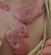 �ֱ��ϵİ̺���ʹ�޸���ʽ-�ൺƤ����ҽԺ