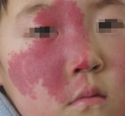 4种护理胎记的措施,胎记患者饮食建议,皮肤病医院