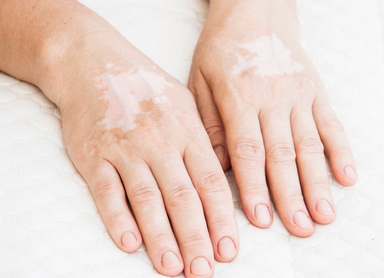 ������ƶ�ͯ�����أ��ൺƤ����ҽԺ����3�ְ��绤����ʽ