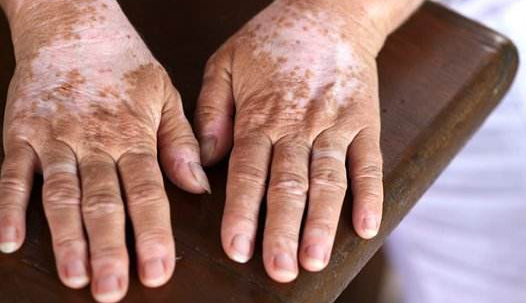 白癜风不会传染吗?白癜风的传播途径有哪些?青岛皮肤病医院