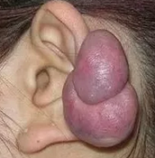 青岛皮肤病医院:耳廓瘢痕疙瘩的特点,瘢痕增生、耳廓软骨膜炎