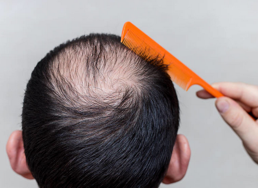 冬天预防脱发应该注意什么?青岛皮肤病医院的3个预防措施